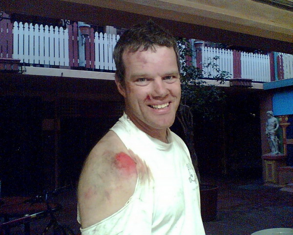 Chris and his mountain bike injuries